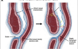 یه تحقیق جدید نشون میده که پس زدن پیوند کلیه به تغییرات تو رگ‌های لنفاوی ربط داره